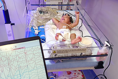 Otoacoustic emissions (OAE)